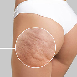 Cellulite Removal